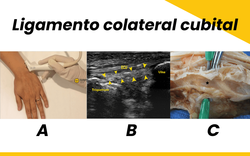 2. Ligamento colateral cubital ecografia tempo formacion.png